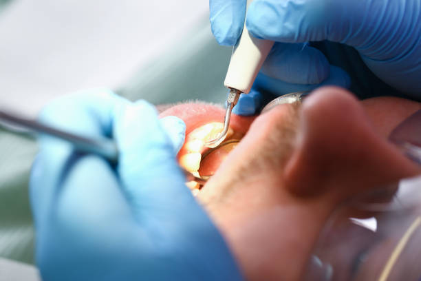 Best Emergency Tooth Extraction in Brown Deer, WI